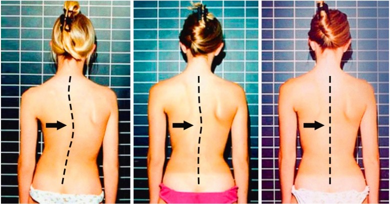 7 Excelentes ejercicios para librarse del dolor de espalda