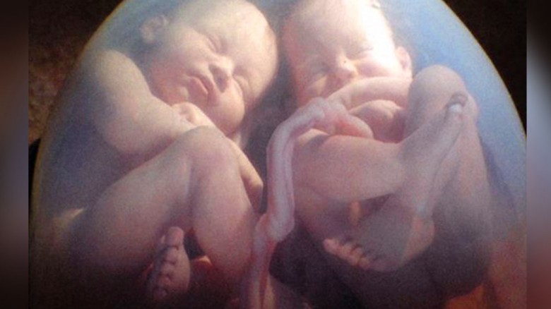 Debes ver la historia de estas gemelas que nacieron tomadas de la mano