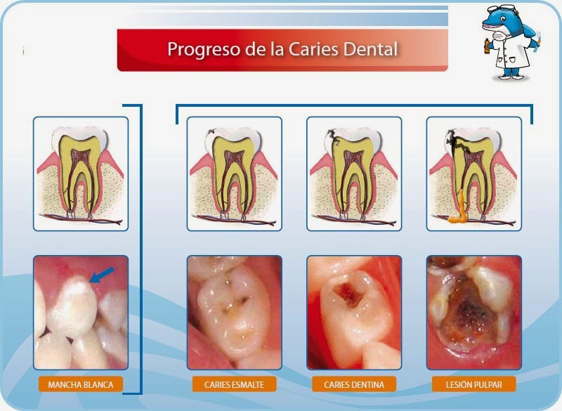 Caries005